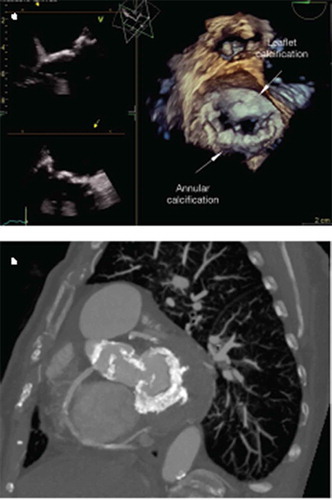 Figure 2. (a) 2 and 3D transoesophageal echocardiography demonstrating extensive severe annular and leaflet calcification resulting in degenerative MS. (b) Circumferential annular calcification demonstrated by multislice computerised tomography.
