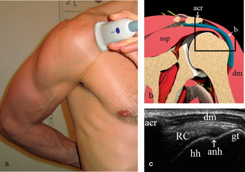Figure 1. Ultrasound examination, lateral longitudinal view, (a) position of the patient and of the transducer, (b) anatomy, (c) ultrasonographic view corresponding to the area within the black rectangle.(Figure 1b reproduced with permission from primal pictures;www.primalpictures.com) Abbreviations:ssp, supraspinatus muscle;acr, acromion;b, bursa;dm, deltoid muscle;RC, rotator cuff;hh, humeral head;anh, anatomical humeral neck;gt, greater tuberosity.