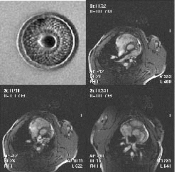 Figure 2. MR image of Amplatzer device prior to implantation (top left). The other images are showing the procedure of deployment of the closure device.