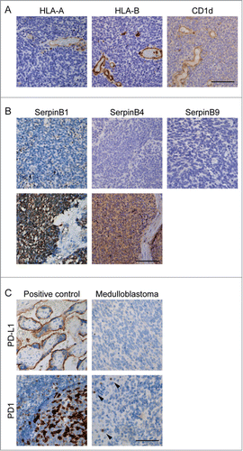 Figure 2. Expression of immune checkpoints and evasion markers in pediatric medulloblastoma. A) Immunohistochemical staining of immune (evasion) markers HLA-A, HLA-B and CD1 d in one case of pediatric medulloblastoma demonstrating that expression of all these markers is absent compared to endothelium and TILs. B) Examples of SerpinB1, SerpinB4 expression in pediatric medulloblastoma. SerpinB9 expression was not detected in pediatric medulloblastoma. C) Expression PD-L1 was not detected in pediatric medulloblastoma by immunohistochemistry. PD-1 positive TILs (arrowheads) are predominantly present at the peripheral zone of the tumor. Positive controls: placenta (PD-L1) and tonsil (PD-1). Scale bar equals 100 μm.