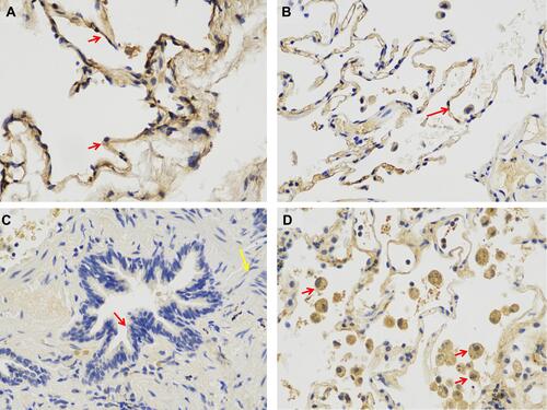 Figure 1 Representative photomicrographs of immunohistochemistry staining of ACE2 in human lung tissues. (A) alveolar epithelial cells (red arrow); (B) vascular endothelial cells (red arrow); (C) small airway epithelial cells (red arrow) and smooth muscles (yellow arrow); (D) alveolar macrophages (red arrow).
