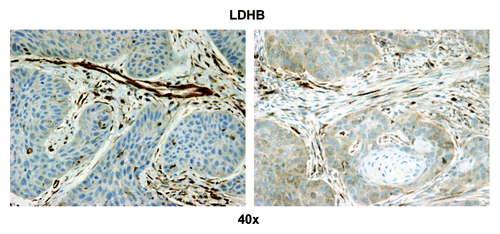 Figure 10. LDHB stromal immunostaining in HNSCC tumor tissue. Note that the stromal cells separating nests of proliferating carcinoma cells have the highest LDHB expression of all the cells in the sample (brown). Original magnification: 40×, as indicated.