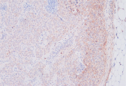 Figure 1.  In the fasL positive lymph nodes the fasL staining was very often seen in the peripheral areas of the nodes. In this specimen the peripheral staining of fasL (fasLp) was scored as 3 and the diffuse nodal staining (fasL) as 20.
