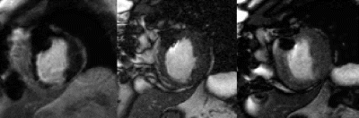 Figure 1. (Left) Delayed hyperenhanced apical short axis image with a 26–50% nontransmural HE region in the septum. (Center) The baseline True Fisp end-systolic image at the same location demonstrating septal hypokinesis. (Right) During dobutamine, improved septal thickening is seen on this end-systolic image, consistent with viability. Note the artifact on all 3 images from the prior LAD stent.