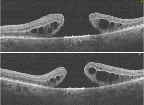 Figure 1 A large FTMH which developed one week after primary vitrectomy for the insertion of glaucoma drainage device (GDD) into the anterior vitreous space.