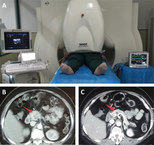 Figure 1 Treatment process and CT imaging of a 65-year-old male patient with pancreatic cancer who received HIFU treatment.Notes: (A) This patient was receiving HIFU ablation in a supine position. (B) Before treatment, a space-occupying lesion with a diameter of about 2 cm could be seen in the pancreatic uncinate process, without pancreatic duct dilated. The CA 19–9 level was tested to be 4370 U/mL. (C) Six months after HIFU treatment, the size and morphology of the pancreas returned to normal, and no visible space-occupying lesions were found in the uncinate process. The CA 19–9 level reduced to 362 U/mL.Abbreviations: CT, computed tomography; HIFU, high-intensity focused ultrasound.