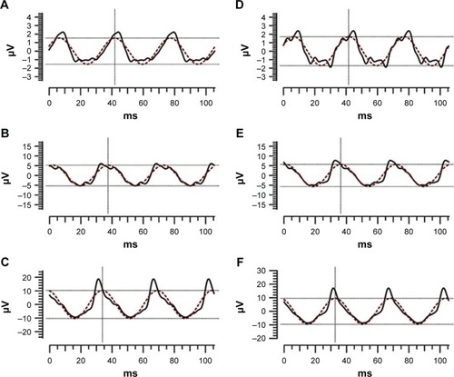 Figure 1 Representative flicker ERGs recorded with the RETeval system elicited by intensities of 2 (A, D), 8 (B, E), and 32 (C, F) Td-s before (A–C) and after (D–F) mydriasis.