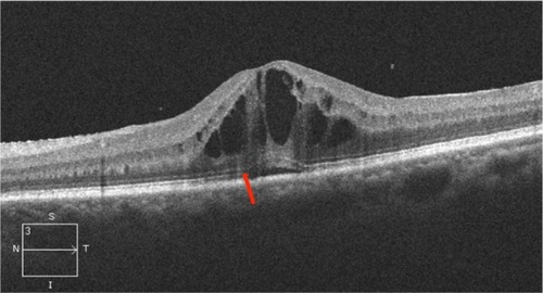 Figure 16 Uveitis associated with macular edema showing discontinuous photoreceptor ISel band and ELM (red arrow), and cystic spaces with serous detachment.