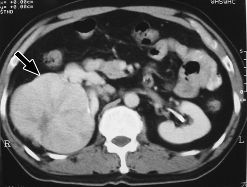 Figure 3. Computed tomography of case 2. An 11-cm exophytic mass (arrow) in the upper pole of the right kidney.