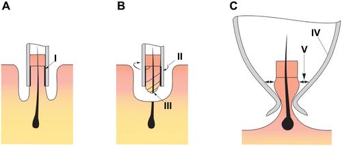 Figure 5 (A and B) Friction between the graft and punch lining – I causes the graft and punch to rotate in unison – II relative to the fixed distal portion of the graft, resulting in twisting and torsion damage – III (C) Frustoconical rooming of the punch lumen – IV minimizes friction between the inner surface of the punch and the graft – V thereby reducing the risk of torsion damage.