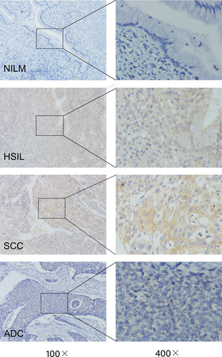 Figure 3 IHC staining for ACTN4 in cervical lesion tissues with different disease severities.