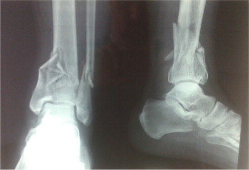 Fig. 1 Initial lower extremity radiographs showing the distal tibial and fibular fractures.