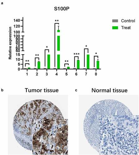 Figure 5. (a) The results of quantitative real-time PCR showed that relative expression level of S100P between tumor and normal tissue. (T1-6: Tumor samples with normal tissues control; C: cell lines with HPDE6-C7 control, C7–8: BxPC-3, SW1990; * P < 0.05; ** P < 0.01; *** P < 0.001.) (b,c) Immunohistochemistry (B: Tumor tissue; C: Normal tissue)