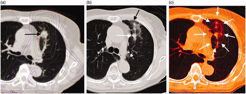 Figure 1. (a) The case is an 85-year-old woman with a 24-mm-diameter squamous cell carcinoma of the left upper lobe S3 lung (black arrow). (b) This shadow was diagnosed as a "Patchy consolidation and ground glass opacity (GGO)" in acute phase CT imaging at 114 days after radiotherapy (black arrow: ground glass opacity, white arrow: consolidation). (c) Treatment planning and acute computed tomography (CT) imaging were fused with MIM Maestro. The shadow of RILI was found in the 80% dose region (white arrows).