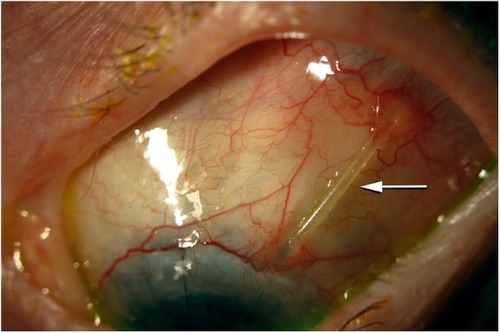 Figure 1 Clinical photograph of one of the eyes in this study with an exposed tube (arrow), with thinning of the allograft pericardium and erosion of the conjunctiva over the silicone tube of the glaucoma drainage device.