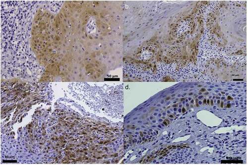 Figure 2. p16INK4a staining. Positive IHC pattern for p16INK4a expression obtained in the samples diagnosed with epithelial dysplasia HPV (+). (400x). Figures (a), (b) and (c) can be described, using Kospokolou 2011 patterns, as patchy positivity patterns and figure (d) as a focal positivity pattern
