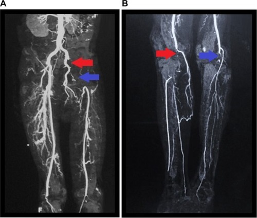Figure 2 (A) CT angiography of lower extremities show intraluminal filling defects with occlusion of the left common iliac artery (red arrow) and left common femoral artery (blue arrow). (B) Intraluminal filling defect with occlusion in the distal popliteal artery of both limbs (red and blue arrows).