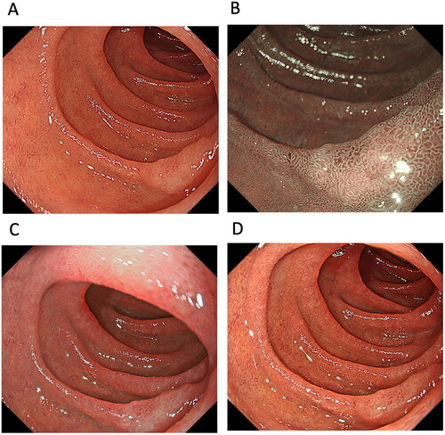 Figure 5. A case of superficial nonampullary duodenal tumour. The tumour observed using (A) white-light imaging, (B) narrow-band imaging, (C) texture and colour enhancement imaging (TXI) mode 1 and (D) TXI mode 2.