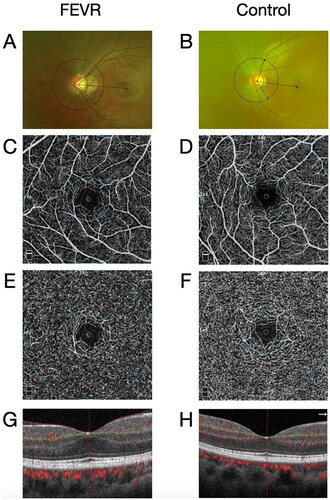 Figure 4. Retinal artery angle, OCTA parameters and incidence of foveal hypoplasia in eyes with FEVR and normal eyes. The FEVR patients had a smaller retinal artery angle (A) than the normal individuals (B). The vascular density of SCP and DCP decreased in the eyes of FEVR patients (C, E) when compared to the normal eyes (D, F). The preserved foveal inner retinal layer was noted in the patients affected by FEVR (G) while the normal individuals had a normal structure (H).