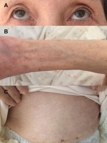 Figure 3 Complete resolution in the bilateral ocular conjunctiva (A), forearm (B), and abdomen (C) two months after one ustekinumab injection.