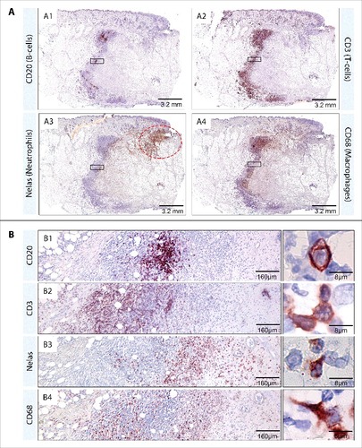 Figure 4. Composition of the immune infiltrate which surrounds the necrotic core. Serial sections from the lesion of patient 5 were stained by immunohistochemistry. The following antibodies were used according to the manufacturer's protocol: Elastase (polymorphonuclear neutrophils, NP57, Dako, M0752), CD3 (T lymphocytes, Dako, A0452), CD68 (macrophages/monocytes, KP1, Dako, M0814), and CD20 (B lymphocytes, 7D1, Novocastra, NCL-CD20–7D1). Pictures were either taken with a Leica DFC 420C camera or with an Aperio ScanScope XT. CD20 positive B-cells (A1, B1) were present in clusters while CD3 positive T-cells (A2, B2), N-elastase positive Neutrophils (A3, B3) and CD68 positive macrophages (A4, B4) were present throughout the infiltration belt in a layered manner. Accumulations of neutrophils were additionally present close to the secondary infection (A3, red dotted circle)