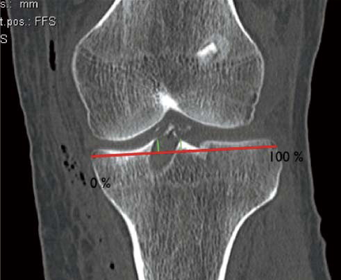 Figure 2. Medial-lateral measurement in the coronal CT reconstruction of the tibial tunnel. The tunnel measurement is compared to the line through the most medial and lateral part of the tibial plateau.