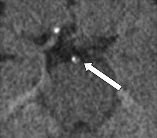 Figure 1 Nonenhanced CT detection of calcified atheromatous plaque (arrow) in a 72-year-old male patient with moderate AD.Abbreviations: CT, computed tomography; AD, Alzheimer’s disease.