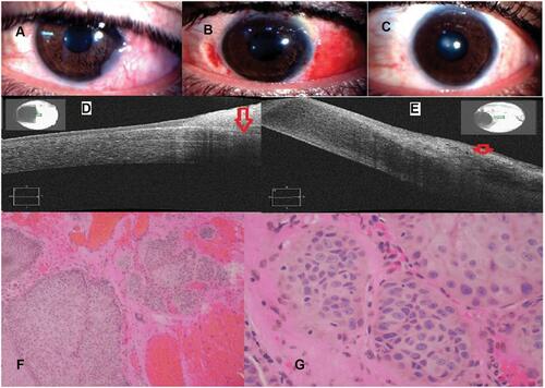 Figure 1 Case 1 (MMC group); a 32-year-old male with OSSN of the left eye (A–C): slit-lamp photographs: (A) preoperative; shows a diffuse gelatinous lesion on the temporal conjunctiva with extensive corneal involvement. (B) One week postoperative; the conjunctiva was edematous and reconstructed with AMG (C) 2-year follow-up shows a complete resolution of the lesion. (D,E) AS-OCT images: (D) preoperative shows a thickened, hyper-reﬂective epithelium (red arrow) and abrupt transitions between normal and abnormal epithelium. (E) 2-year follow-up; in the area of the previous lesion shows back to a normal thin epithelial thickness and appearance (red arrow). (F,G) Histopathological specimen [H&E, low power (F) & high power (G)]; sections reveal squamous cell proliferation forming sheets & solid nests extending from the surface epithelium down to the subepithelial level. The squamous cells are atypical showing large nuclei, multiple eosinophilic nucleoli with frequent mitosis and atypical forms. The intercellular bridges between the squamous cells are readily seen. There are many individually keratinized cells with small pearl-like structures. This is consistent with invasive squamous cell carcinoma, moderately differentiated.