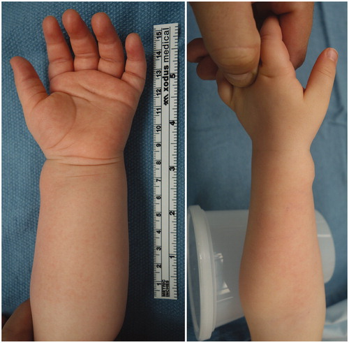 Figure 1. On initial presentation, the patient had a 1 cm slightly bluish, pulsatile, non-tender soft tissue mass over the course of the left radial artery, concerning for a vascular anomaly.