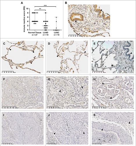 Figure 4. Loss of SFRP3 protein expression in human squamous cell carcinoma and adenocarcinoma of the lung. (A) Scatter plot analysis represents reduced SFRP3 immunoreactivity in primary LUAD samples (median: 2) and loss of SFRP3 protein in LUSC tissue (median: 0) compared to normal lung tissue (median: 4). Horizontal lines: median value. Vertical lines: probe ranges. **P < 0.01 ***P < 0.001 (B) Clear positive immunoreactivity in ciliated bronchial epithelium. (C and D) Strong SFRP3 protein staining in normal lung tissue, especially in type I and II pneumocytes of alveolar walls. (E) Negative control of normal lung tissue. Primary antibody was omitted. (F to H) Low SFRP3 immunoreactivity in the cytoplasm of advanced adenocarcinoma of the lung, indicating an IRS of 2 (F and G) and an IRS of 4 (H). (I to K) Loss of SFRP3 staining in the cytoplasm of primary squamous cell carcinoma samples, IRS of 0.