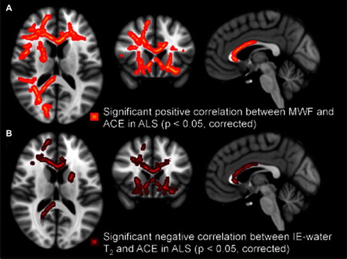 Figure 2. Regional white matter tract correlations, notably including the anterior corpus callosum and frontal projections, between lower ACE scores and reduced MWF in ALS patients (A), and increased IE-water T2 in ALS patients (B). All p-values corrected for multiple comparisons. Images displayed by radiological convention.