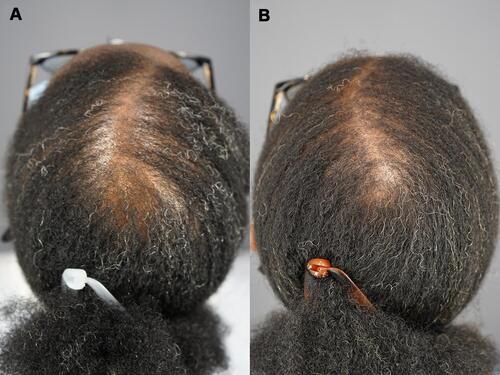 Figure 2 Vertex and back of the head of patient 1 Images of the vertex and back of the head of a patient diagnosed with central centrifugal cicatricial alopecia before (A) and after (B) treatment with Gashee lotion and oral supplements.