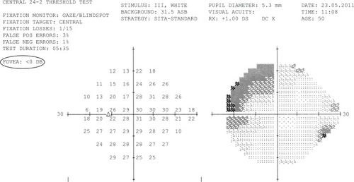 Figure 1 Central 24 degree perimetry from May 2011 showing peripheral deep defects and no defects within the 10 central degrees. Foveal threshold is zero dB (shown by oval gray line).