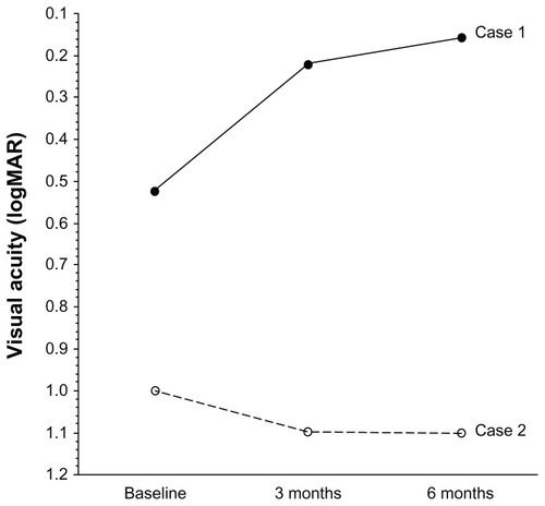 Figure 3 Changes in best-corrected visual acuity after intravitreal injection of triamcinolone acetonide in two patients with branch retinal vein occlusion and macular edema. Case 1: best-corrected visual acuity is improved after 3 and 6 months. Case 2: best-corrected visual acuity is not improved after 3 or 6 months.