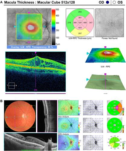 Figure 4 (A) Diabetic macular edema persistent after 10 intravitreal bevacizumab and 13 aflibercept injections over 40 months. (B) Resolution of macular edema one month after DEX implant.