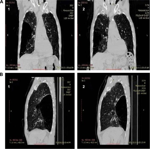 Figure 3 HRCT with coronal reconstruction (A) and sagittal reconstruction (B) in patient who underwent BLVR with autologous blood.Note: Reduction in emphysematous part at 12 weeks postprocedure (2) compared to baseline images (1).Abbreviations: BLVR, bronchoscopic lung volume reduction; HRCT, high resolution computerized tomography.