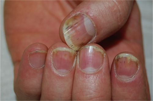 Figure 2 Nail bed psoriasis of fingernails.