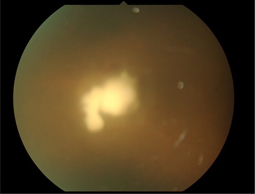 Figure 4 Fungal mass on the right retina.