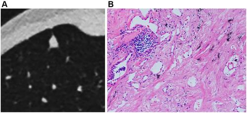 Figure 4 Solid SPIN with polygonal shape (type IV) (A). It has homogeneous density and smooth margin. Pathologically, it consists of fibrous tissue proliferation, hyaline change and a small amount of inflammatory cells infiltration (B).