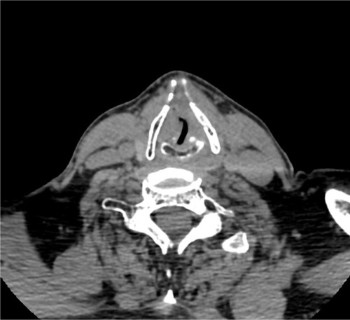 Figure 2 Computed tomography scan at level of entrance to larynx showing tumor mass obscuring glottis.