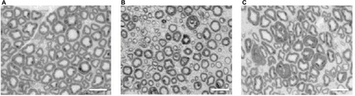 Figure 3 Micrograph images of the sciatic nerve of a nondiabetic rat (A), a diabetic rat with compression only (B), and a nondiabetic rat with compression only (C). There was evidence of demyelination found in the diabetic and nondiabetic rats in the compression-only groups. Scale bar: 20 µm.