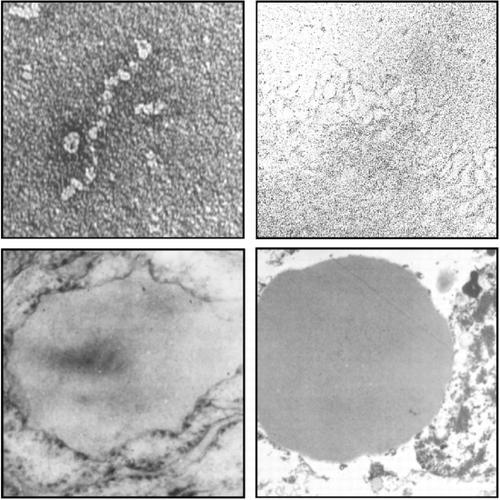 Figure 5. Polymerisation and inclusion bodies. Upper: Z antitrypsin readily undergoes loop‐sheet linkage Citation[95] to give bead‐like polymers (left) which become entangled (right) to form intracellular inclusions (electron micrographs × 220 000). Below ( × 20 000). Inclusions formed of entangled polymers of conformationally unstable serpins are seen with antitrypsin in the rough endoplasmic of reticulum of hepatocytes (on left), and with homologous mutations in neuroserpin in neurons, on right Citation[10].