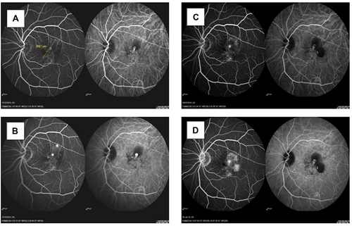 Figure 8 FFA/ICGA images at baseline and post-injections showing persistent PL on FFA/ ICGA after three aflibercept injections of combination therapy patient.