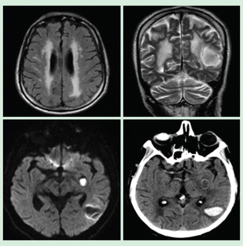Figure 1. Cranial magnetic resonance images showing diffuse hyperintensity in bilateral periventricular and deep subcortical white matter, a resorbing chronic hematoma localized in the left basal ganglion and an acute lobar hematoma in the left temporoparietal cortico–subcortical region.