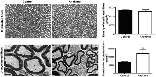 Figure 2. Anakinra prevents neurodegeneration in the Hsf/V30M FAP mouse model. Morphometric analyses of sciatic nerve segments in Anakinra-treated and control animals. (A) Fiber density assessed in semithin sections showing no impact of IL-1 blocking on myelinated fibers. Scale bar: 50 µm, n = 6 animals within each group. (B) Electron microscopy representative images, and correspondent chart, indicating higher unmyelinated fiber density in Anakinra-treated animals, as compared to controls. Scale bar: 2 µm, n = 6 animals per group (*p < 0.05).