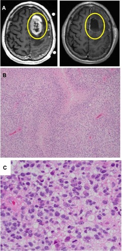 Figure 1 Radiographic (MRI) images and histology of GBMs.