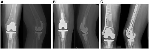 Figure 1 Post-operative X-rays from case report patients 1–6 (A) AP and lateral of knee for Patient 1 with TKA and no additional treatment required for cartilaginous tumor. (B) AP and lateral of knee for Patient 5 with TKA and curettage with cement augmentation required for cartilaginous tumor. (C) AP and lateral of knee for Patient 6 who underwent curettage with cement augmentation and internal fixation of cartilaginous tumor prior to treatment of OA with a TKA.