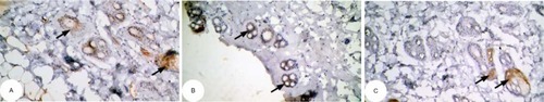 Figure 15 Photomicrographs of immunohistochemically stained breast tissue sections showing the effect of Ulva lactuca polysaccharides on antiapoptotic marker bcl-2 expression (indicated by the arrows) (A, B, and C; ×400).