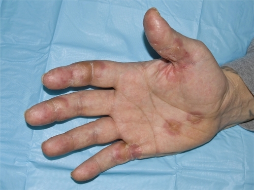 Figure 1 Grade 3 hand-foot syndrome including acral erythema, hyperkeratotic areas, and desquamation. Considered grade 3 due to pain interfering with function.