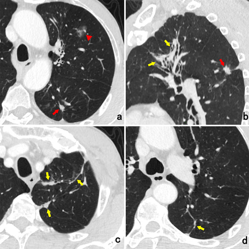 Figure 1 A 67-year-old man with non-neoplastic GGN. An oval part-solid nodule (arrowhead) with well-defined boundary and lobulation sign locates in the left upper lobe (A). It is suspected as neoplastic lesion. On axial and sagittal CT images (a-d), multiple solid nodules (red arrows), fibrosis and patchy opacification (yellow arrows) are detected in the same lobe and ipsilateral lung field (a-d). (GGN, ground-glass nodule).